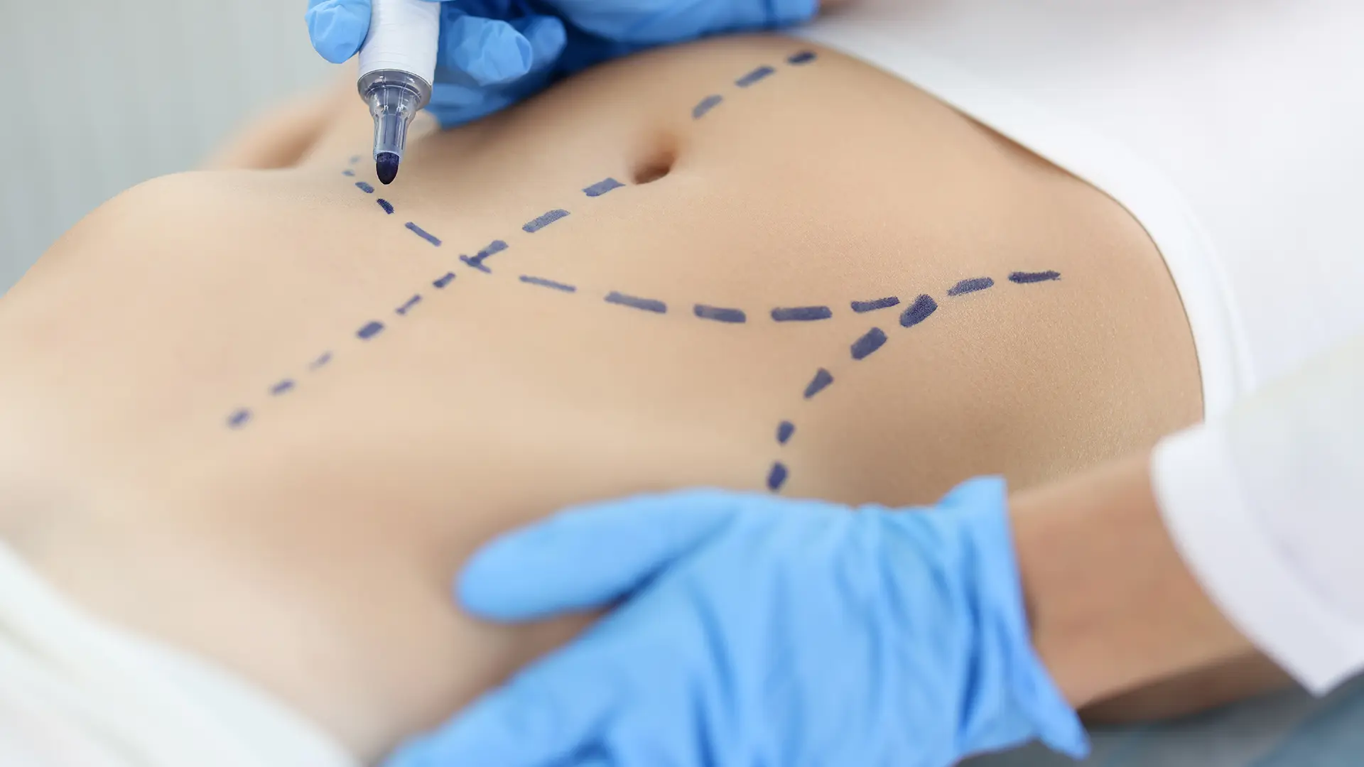 tratamento-abdominoplastia