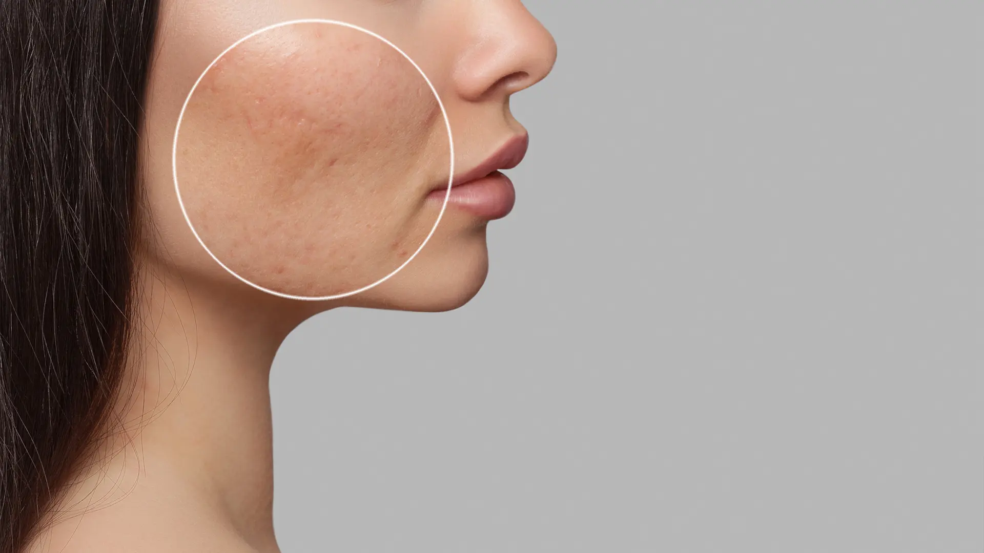 tratamento-correcao-cicatrizes-acne